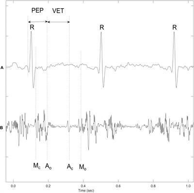 Fetal Cardiac Timing Events Estimation From Doppler Ultrasound Signals Using Swarm Decomposition